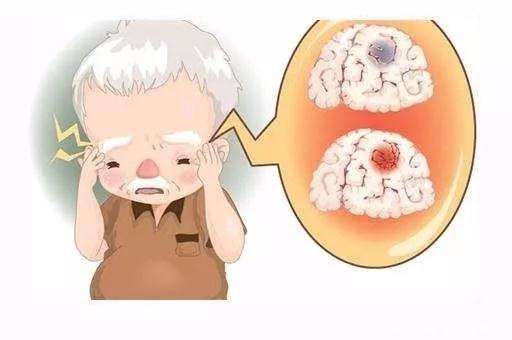 經(jīng)顱磁治療儀_患腦梗塞一般有哪些后遺癥