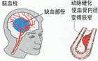 經(jīng)顱磁刺激儀家用_患腦血栓一般前兆是什么 