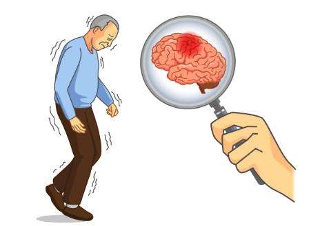 帕金森病影響壽命嗎?經(jīng)顱磁刺激儀有效嗎?