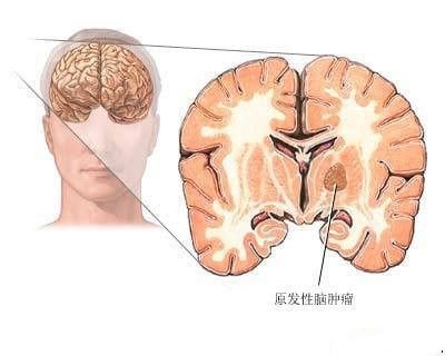 經顱磁對大腦有傷害嗎_治療癲癇病應該注意什么