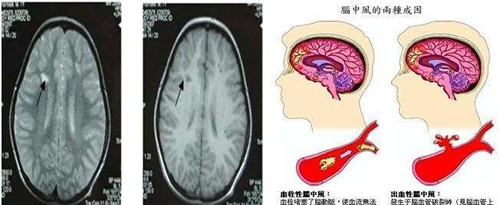 經顱磁刺激治療_腦血栓有什么好的預防方法