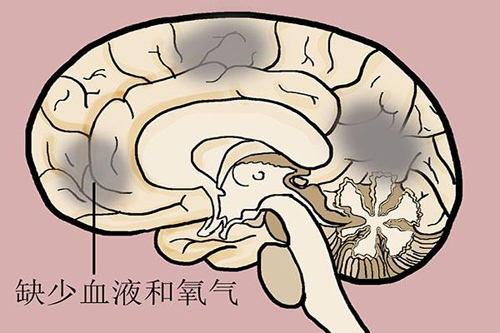 經顱磁|腦梗塞患者要注意哪些護理方法