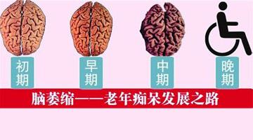 經顱磁刺激常見問題_預防腦萎縮有什么措施