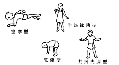 安全的物理療法_小孩子有智力低下還能不能好了